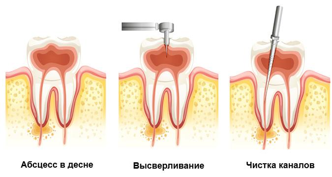 Профилактика и лечение зубных кист